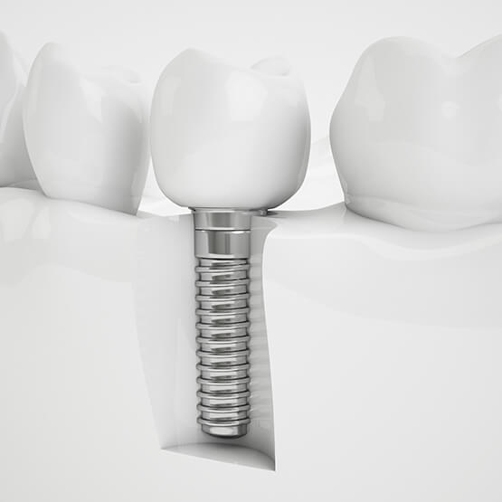 1764872592_dentalimplant555x555